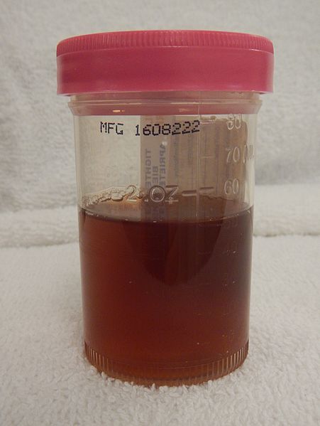 urine sample which is bloody and brown to red