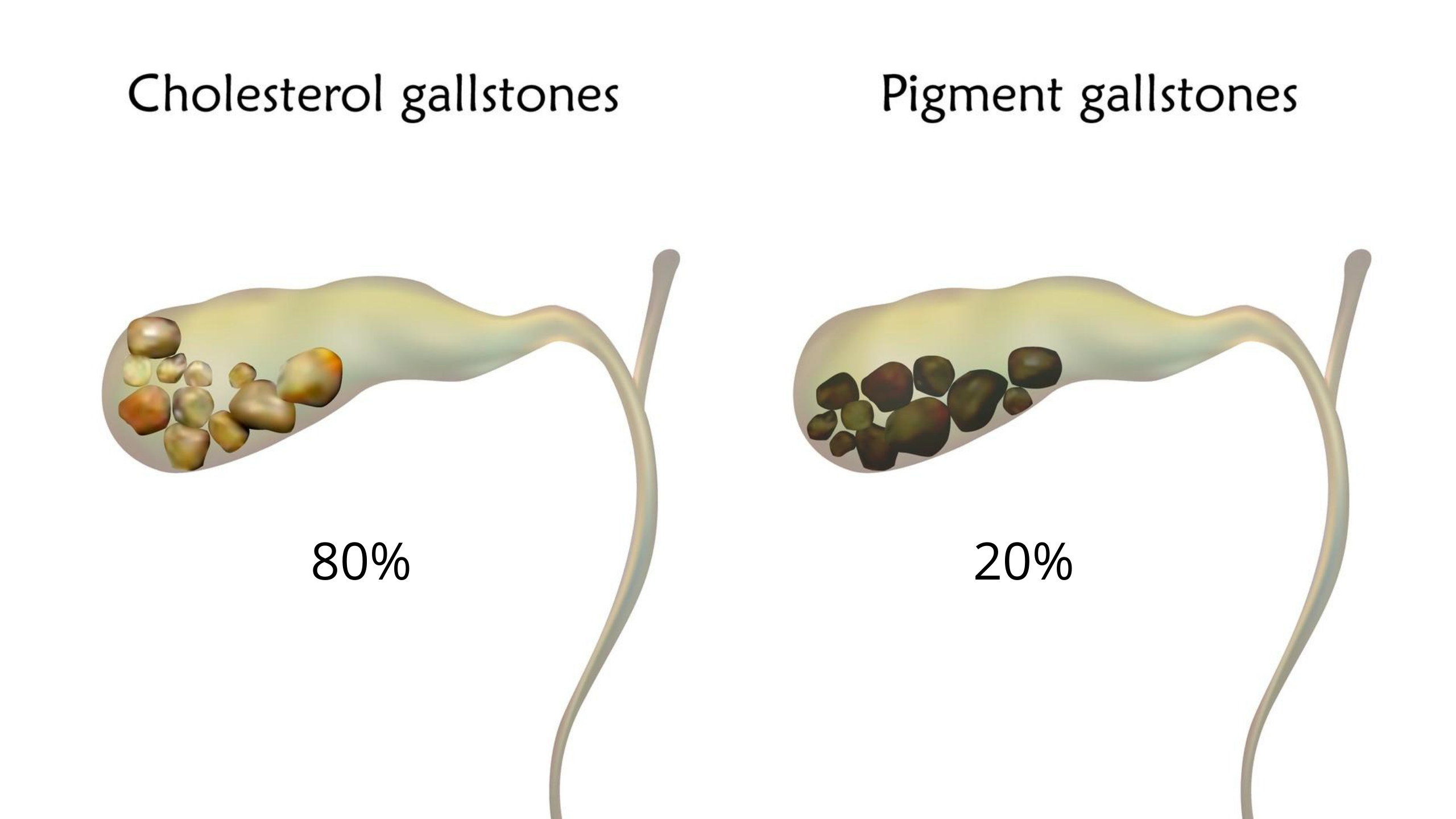 gallbladder stones in gallbladder