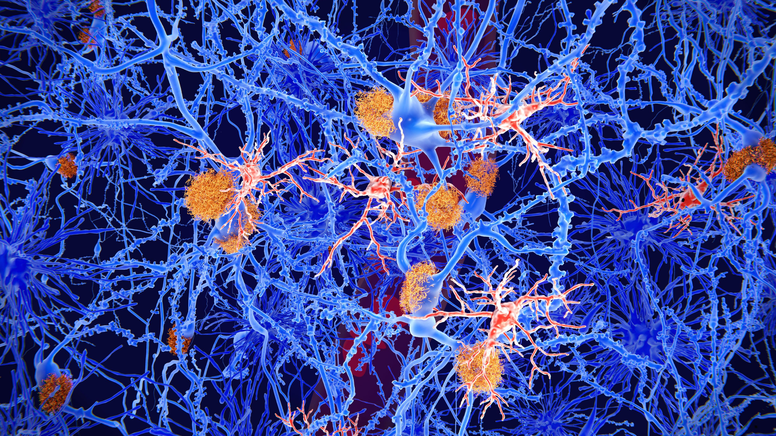amyloid plaques in brain