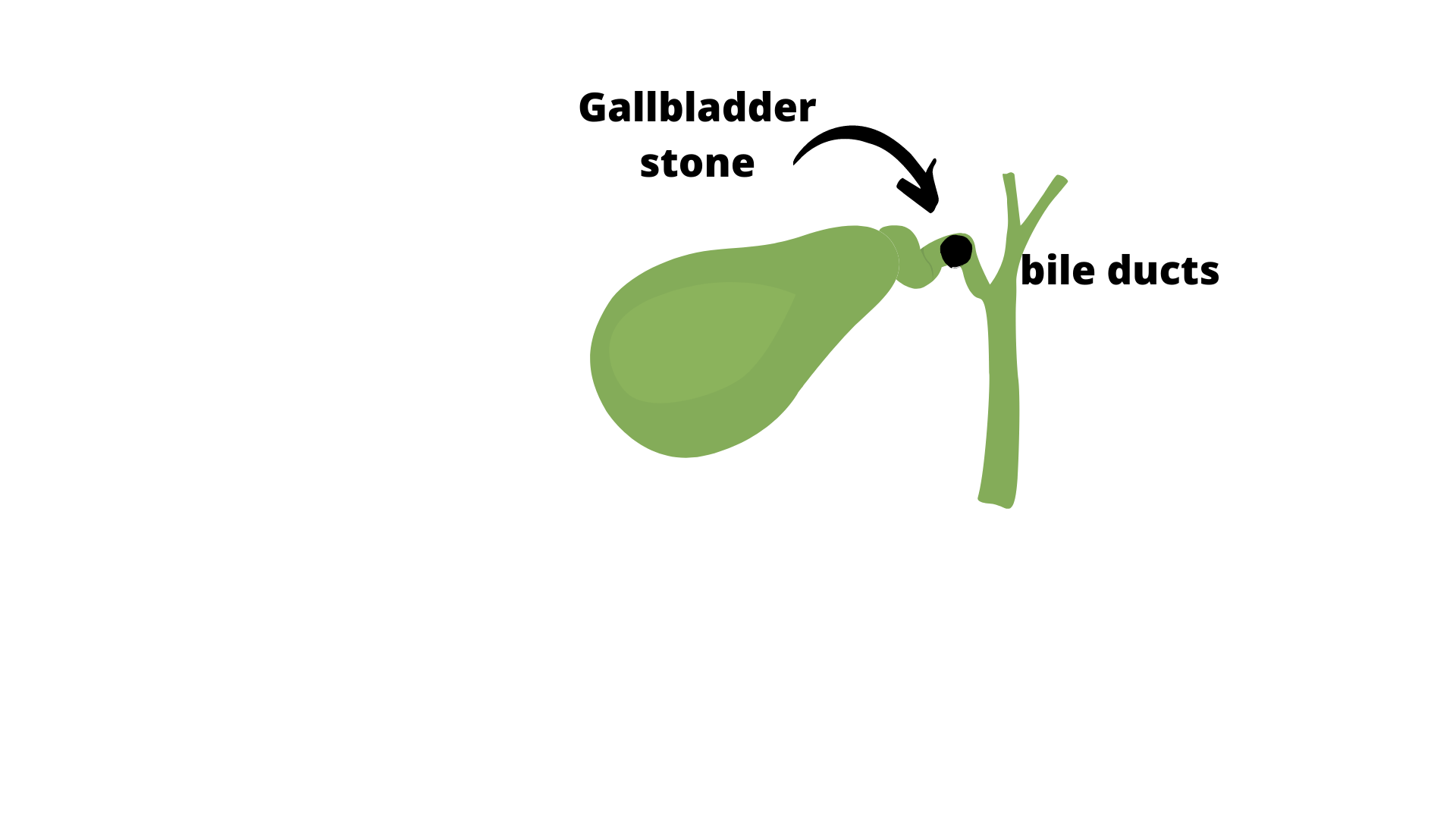 gallbladder stone with bile duct