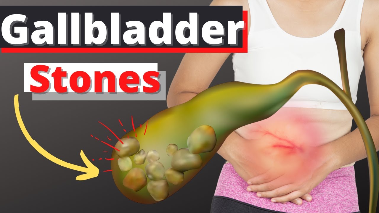 woman holding abdomen in pain with gallbladder stones