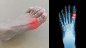 x ray and foot showing gout