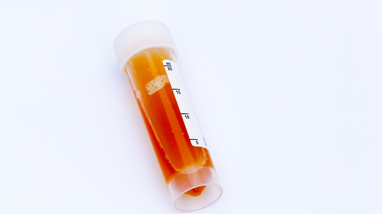 urine sample of dark red urine