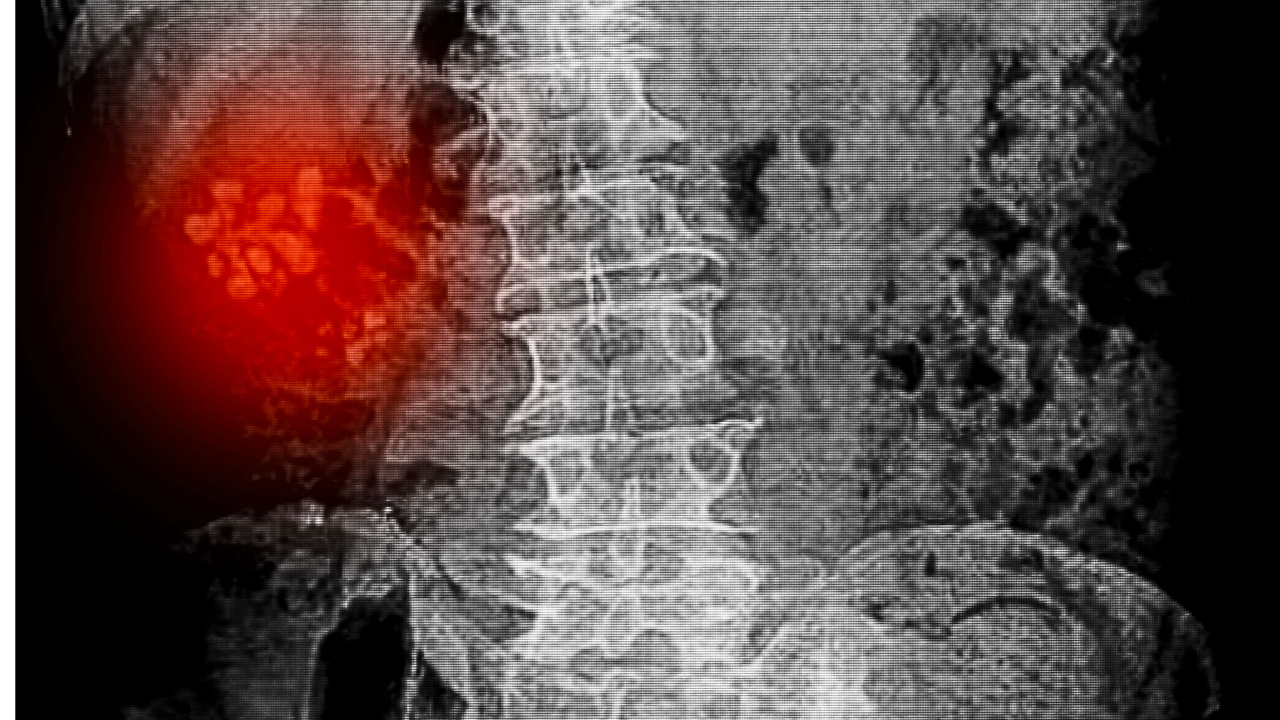  x ray of kidney stones