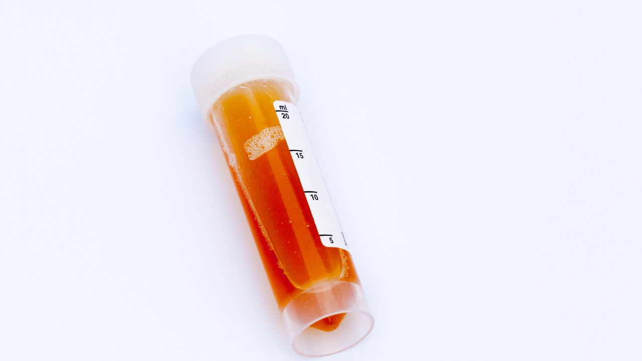 tube holding reddish urine