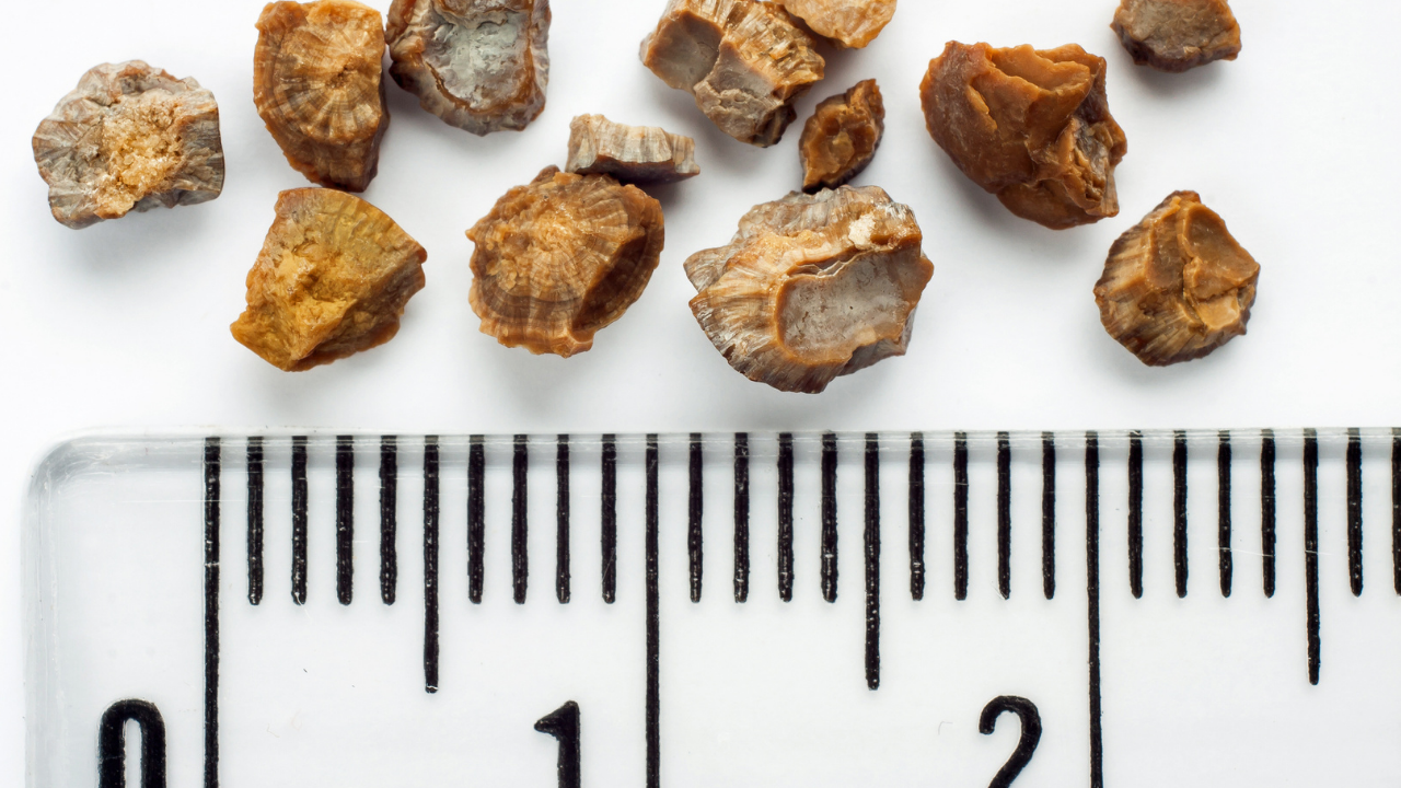 Multiple kidney stones with measurement