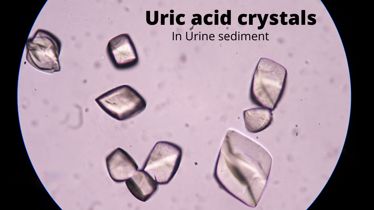 uric acid crystal under microscope