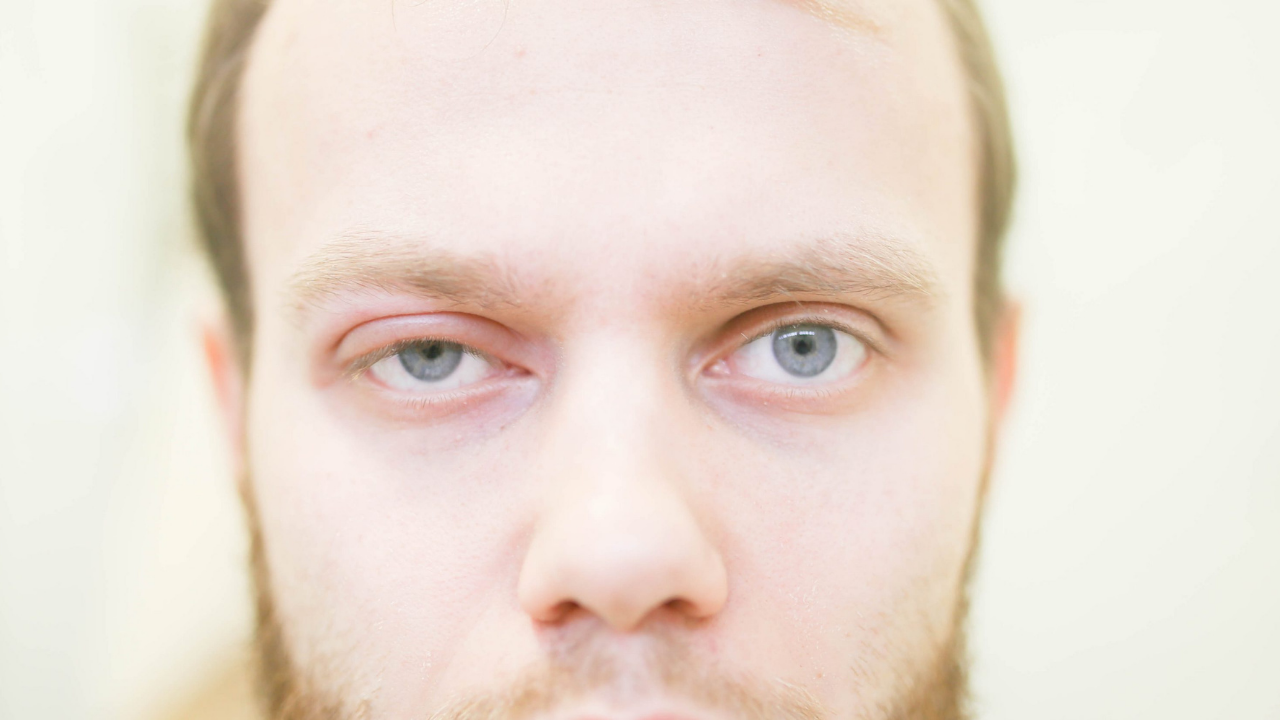 man with swelling of face and eyelids