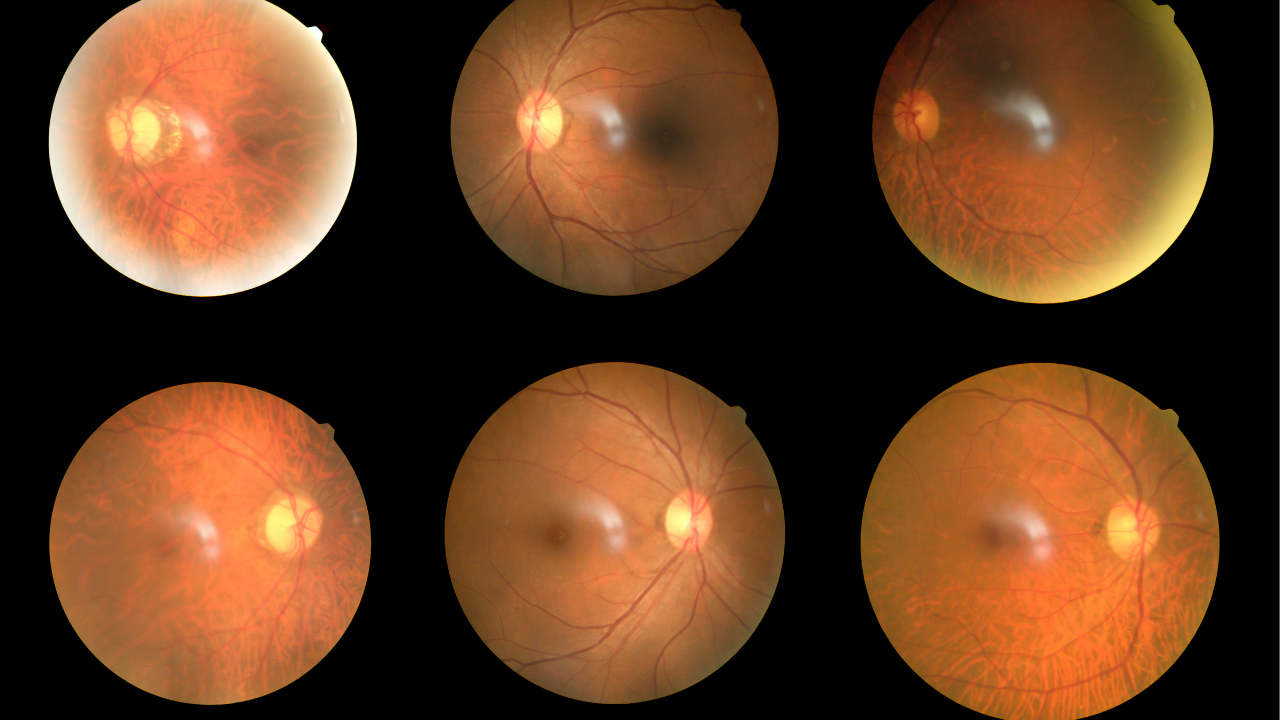 fundus of eye showing diabetic retinopathy