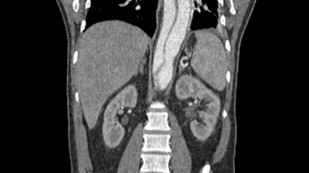  Ct scan of aortic dissection