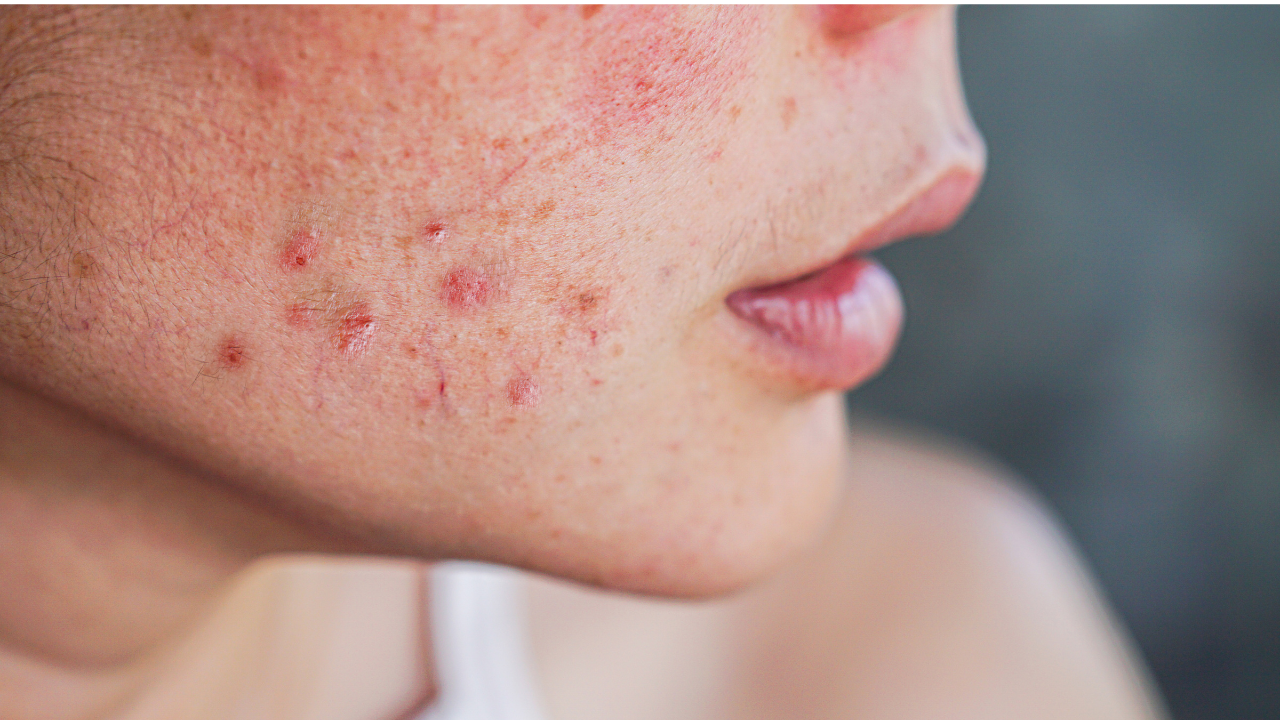 face with acne pimples