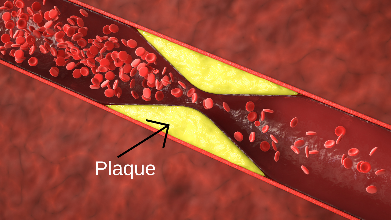 vessel with plaque deposition