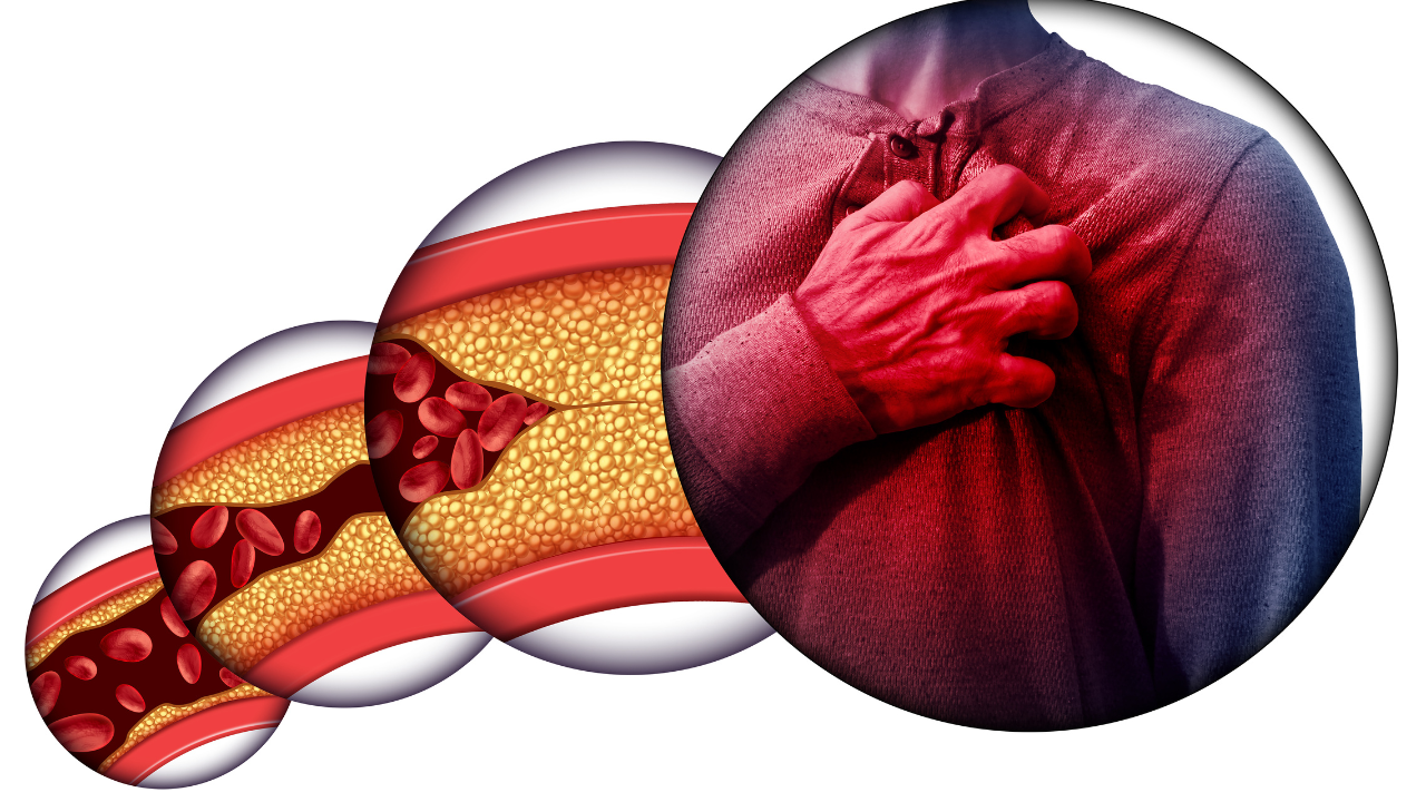 various stages of plaque formation in the heart