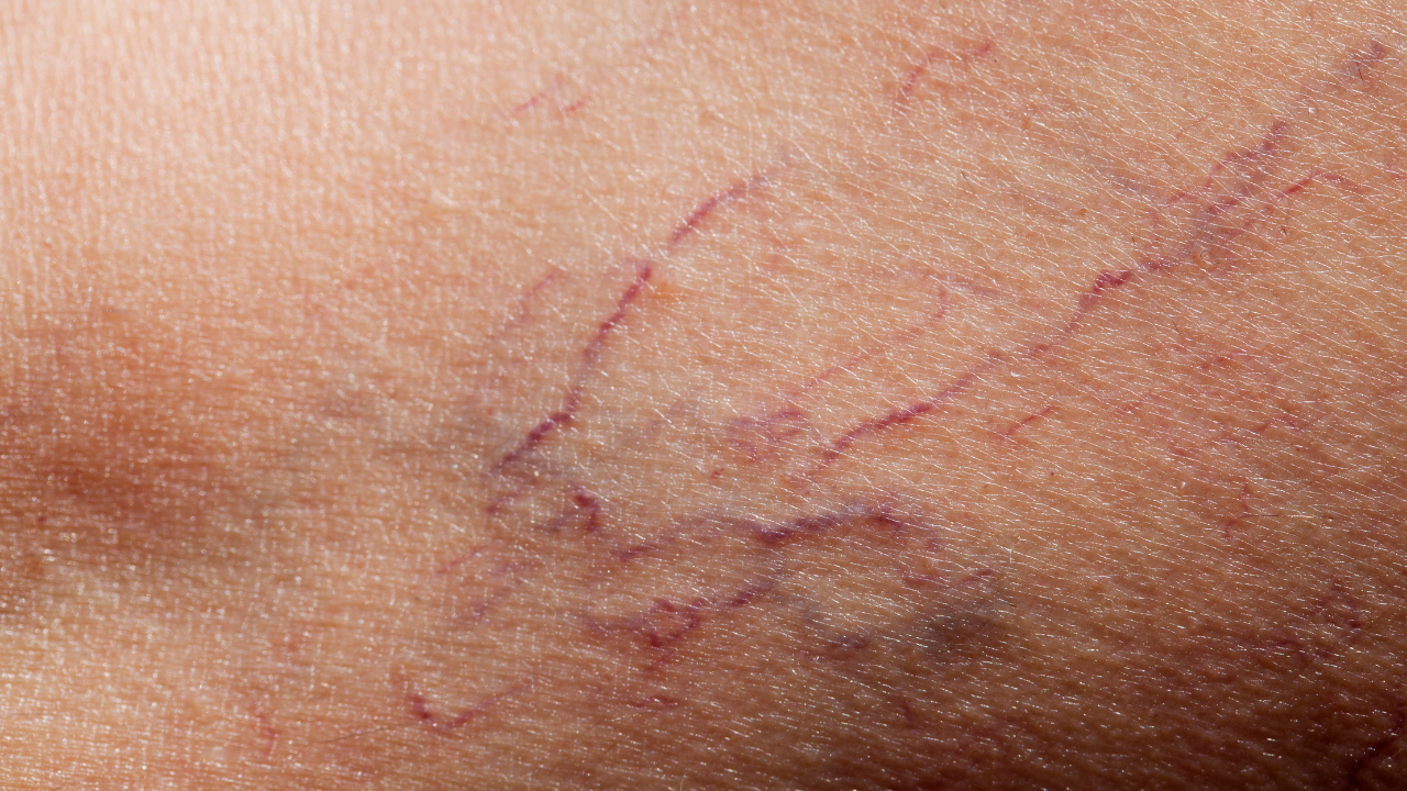 close up of reddish spider veins