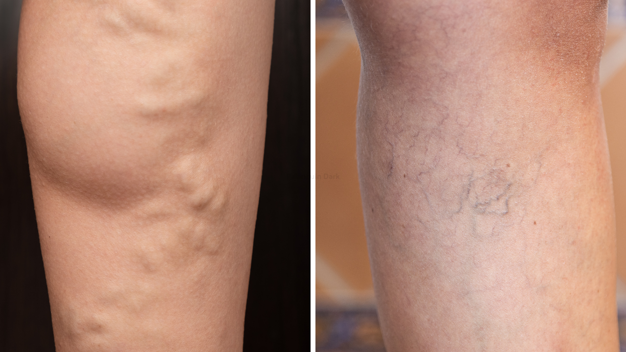 close up of varicose veins and dilated veins